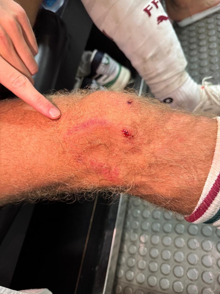 Así le quedó la rodilla a Castillo tras la infracción de Pulgar. (Foto: prensa Fluminense)